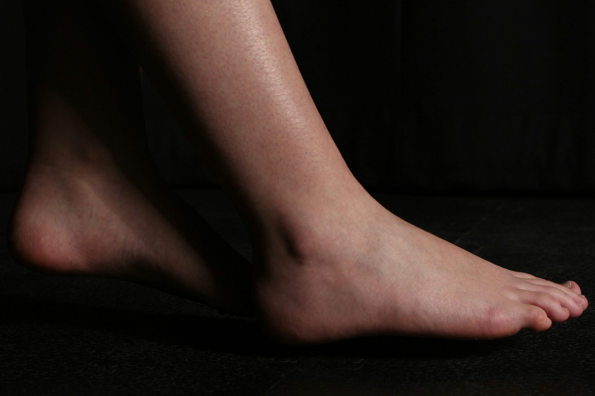 Sever's disease is a common cause of heel pain in active children and teenagers